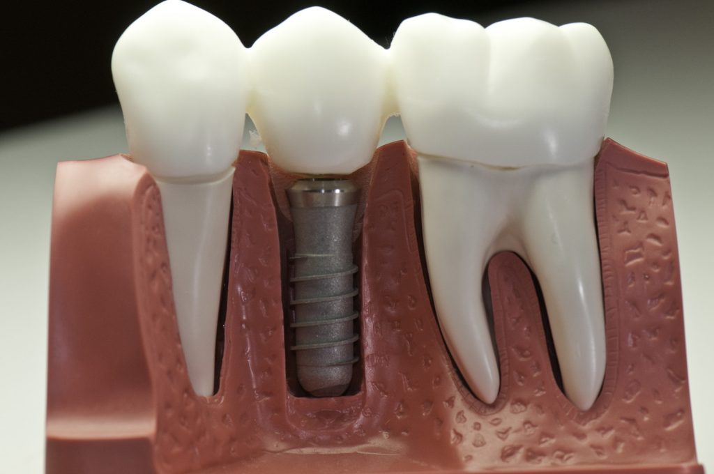 why are dental implants the best option for replacing teeth