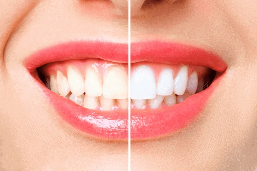 your most common teeth whitening questions answered