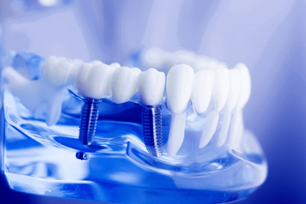 what are the top benefits of dental implants